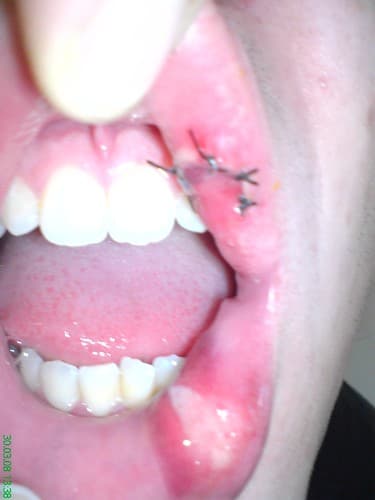 My busted lip O.o